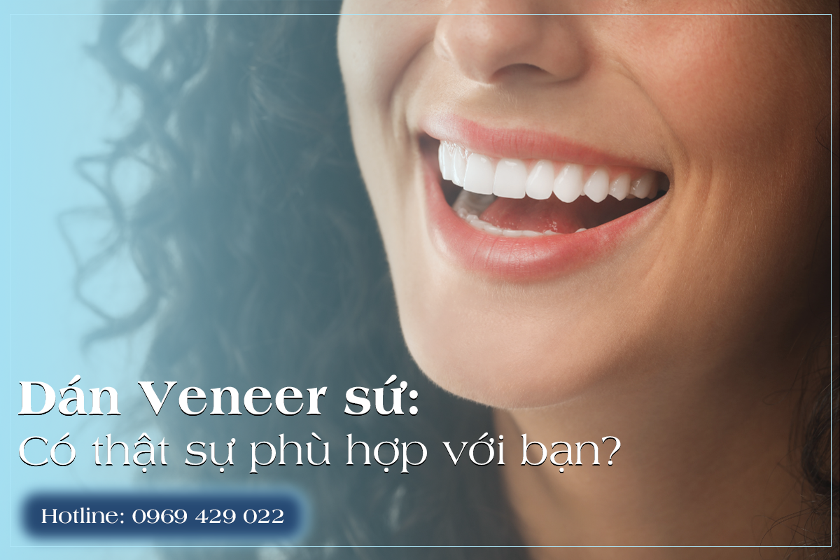 Veneer sứ ngày càng được nhắc đến như một giải pháp cải thiện nụ cười tinh tế, nhẹ nhàng và ít xâm lấn. Không còn chạy theo những hàm răng quá trắng hay quá đều, nhiều người bắt đầu quan tâm đến một câu hỏi thực tế hơn: Veneer sứ là gì ? Liệu mình có cần bọc răng sứ toàn bộ?