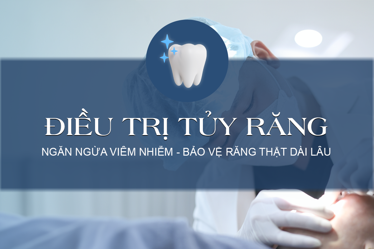 Điều trị tủy răng là quá trình loại bỏ phần tủy bị tổn thương, làm sạch và khử trùng toàn bộ hệ thống ống tủy, sau đó trám kín lại để ngăn vi khuẩn quay trở lại. Mục tiêu chính của điều trị tủy là bảo tồn răng thật, tránh phải nhổ răng và giữ chức năng ăn nhai lâu dài.
