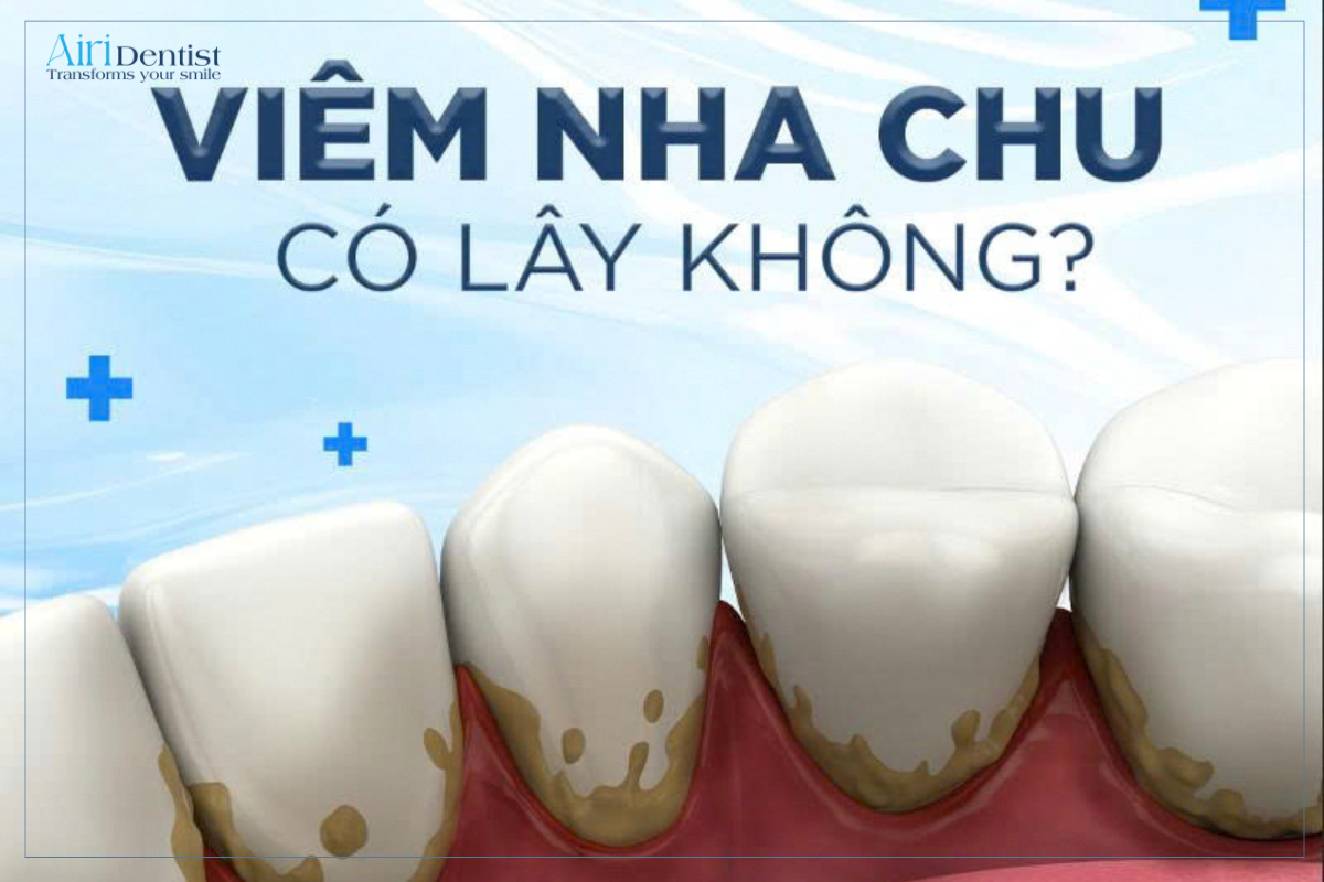 Viêm nha chu có lây không? Tìm hiểu nguy cơ lây nhiễm qua nước bọt, nguyên nhân và cách phòng ngừa hiệu quả để bảo vệ sức khỏe răng miệng cho bạn và gia đình.