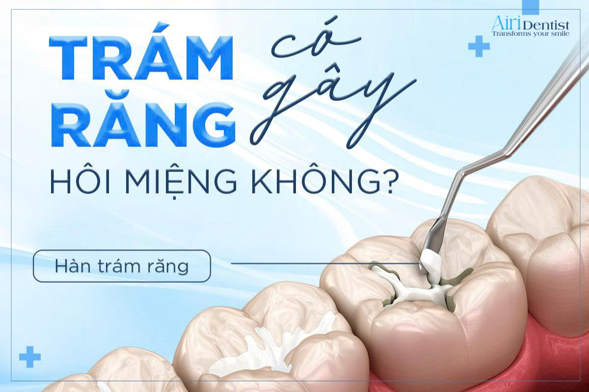 Trám răng gây hôi miệng là thắc mắc khá phổ biến của nhiều người sau khi điều trị sâu răng hoặc phục hồi răng bằng vật liệu trám.