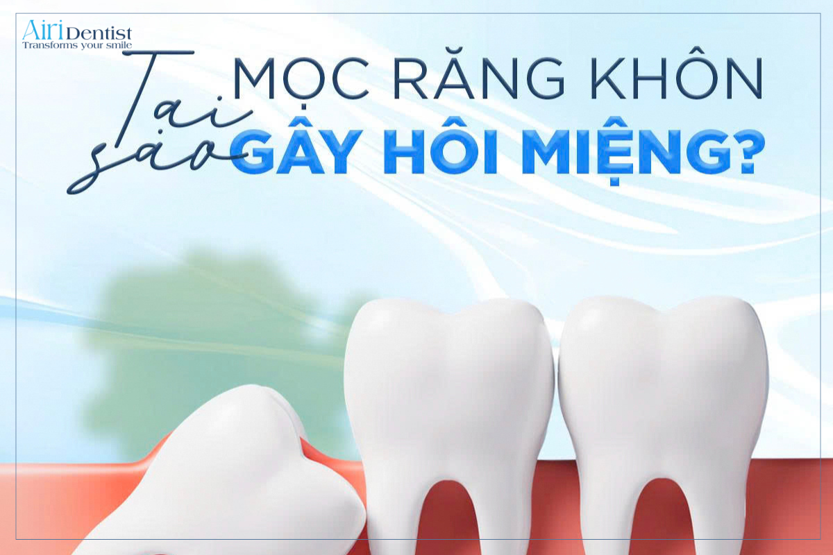 tình trạng mọc răng khôn bị hôi miệng khá phổ biến và thường xuất phát từ nhiều nguyên nhân khác nhau liên quan đến vi khuẩn, viêm nhiễm hoặc việc vệ sinh răng miệng khó khăn ở khu vực răng khôn.