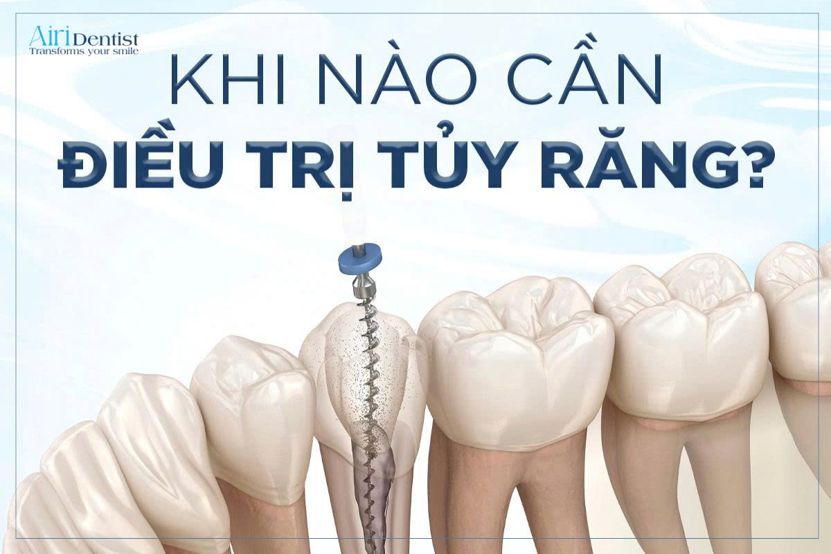Điều trị tủy răng giúp bảo tồn răng khi tủy bị viêm hoặc hoại tử. Tìm hiểu các dấu hiệu cần chữa tủy răng và khi nào nên đi khám nha sĩ.