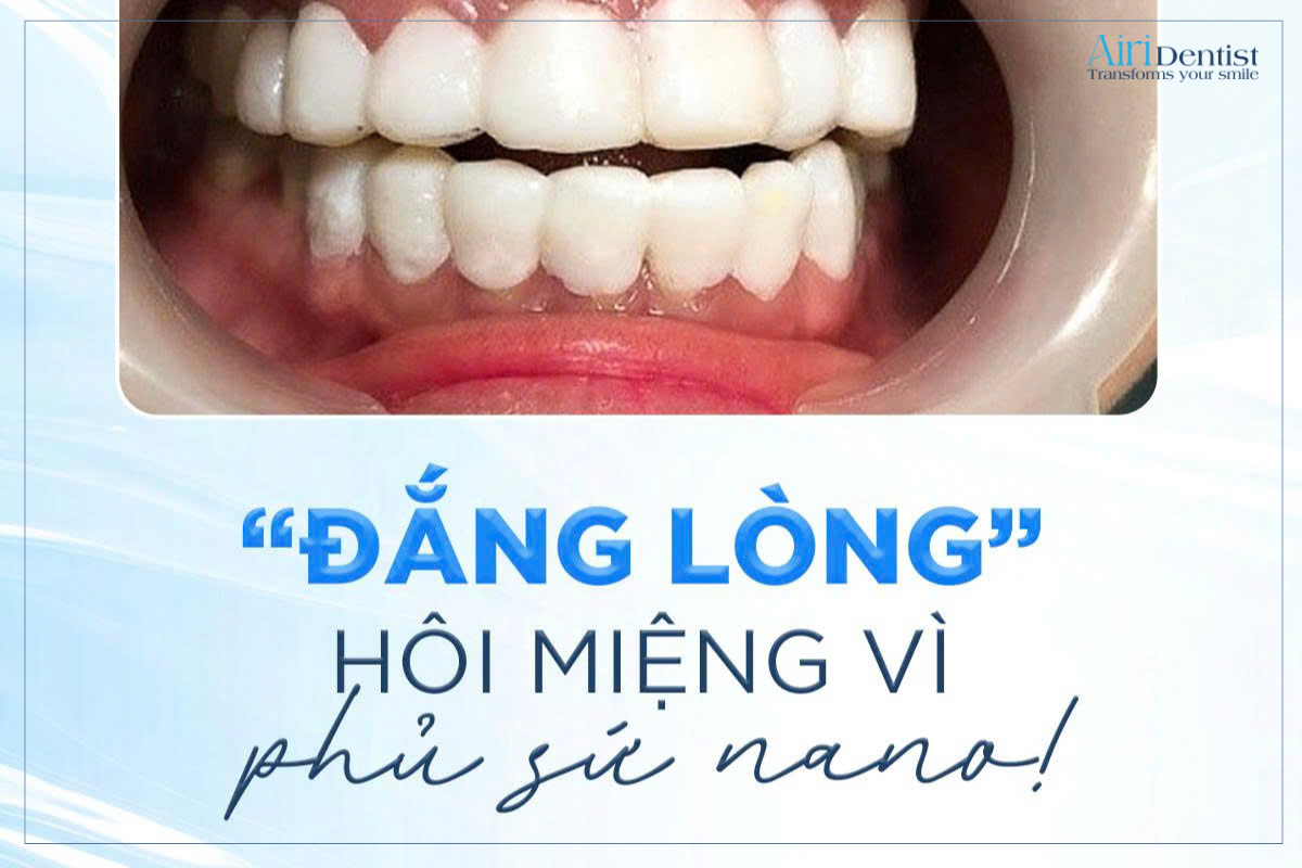 Hôi miệng sau khi phủ sứ nano là tình trạng nhiều người gặp phải do kỹ thuật thực hiện hoặc vệ sinh răng miệng chưa đúng cách. Tìm hiểu nguyên nhân và cách xử lý hiệu quả.