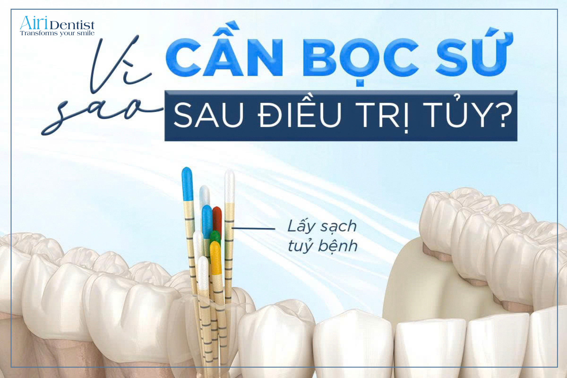 Răng mất tủy rất dễ vỡ. Khám phá ngay 4 lý do bác sĩ khuyên bạn nên bọc răng sứ sau khi điều trị tủy để bảo vệ răng thật và giữ nụ cười bền đẹp.