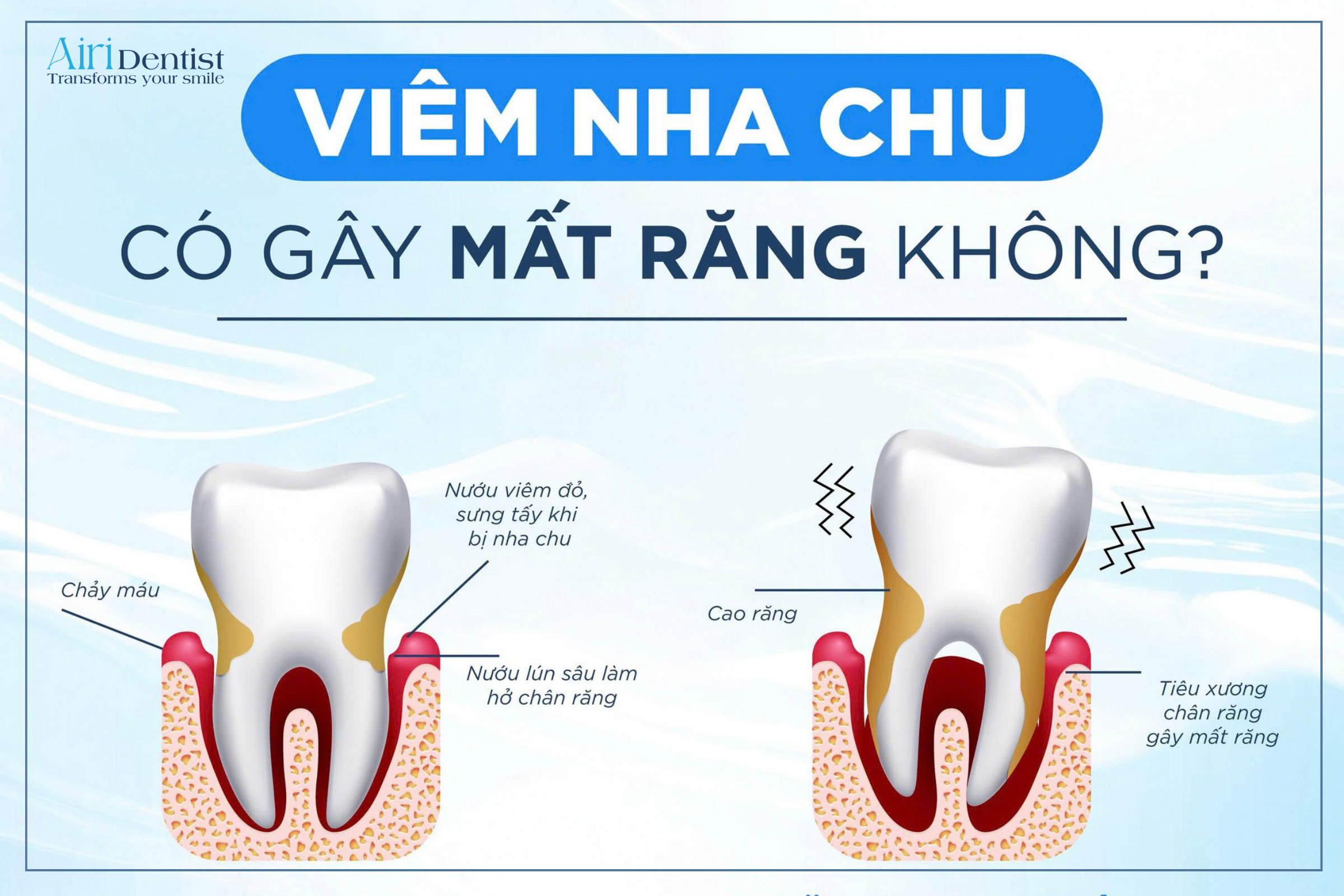 Bệnh lý viêm nha chu có gây mất răng không? Tìm hiểu ngay 5 giai đoạn phát triển của bệnh và lý do bạn cần lấy cao răng định kỳ để bảo vệ nụ cười khỏe mạnh.