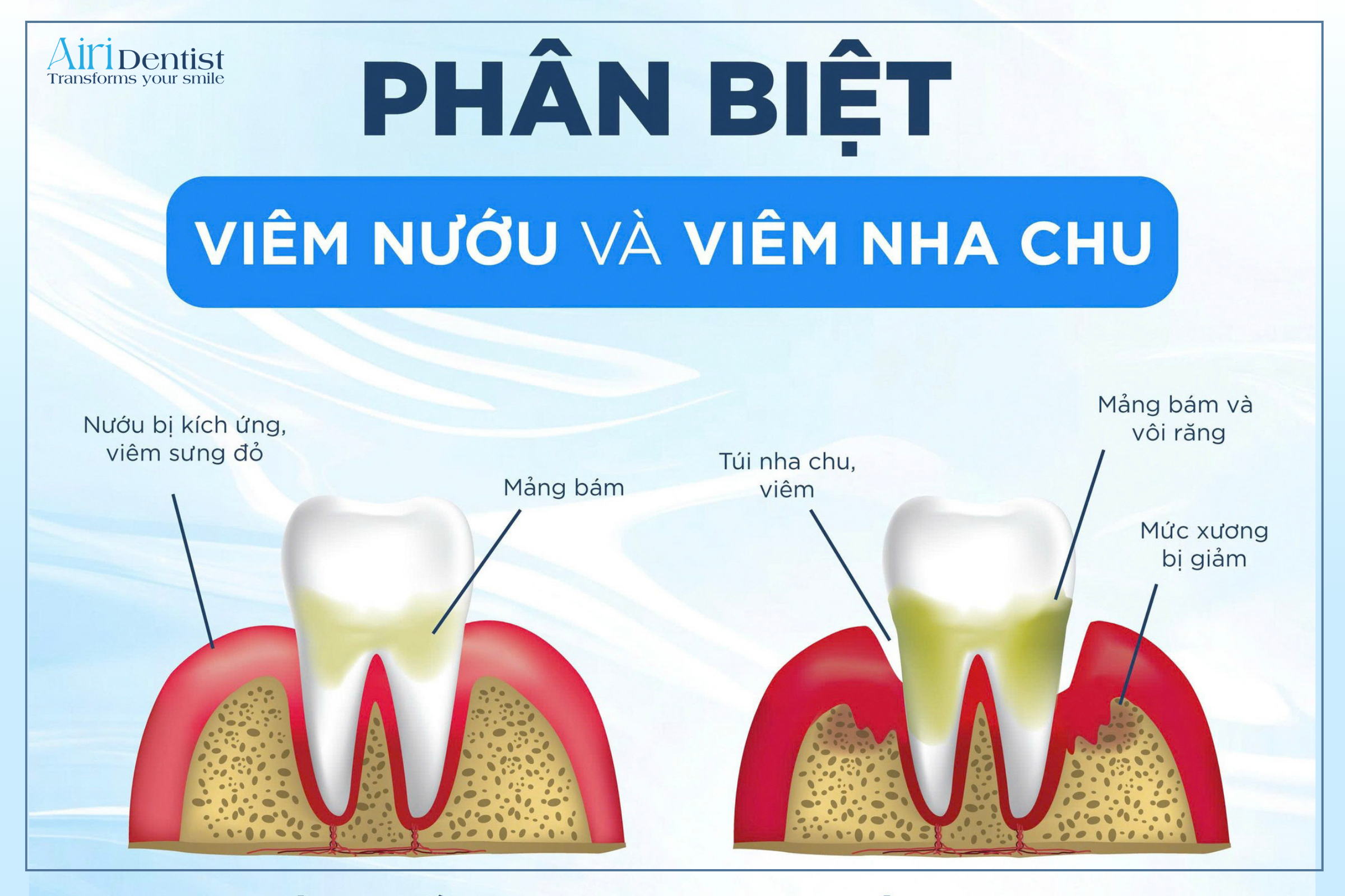 Chảy máu chân răng là biểu hiện của viêm nướu hay viêm nha chu? Đọc bài viết phân tích chuyên sâu để phân biệt viêm nướu và viêm nha chu, từ đó có phác đồ điều trị kịp thời.