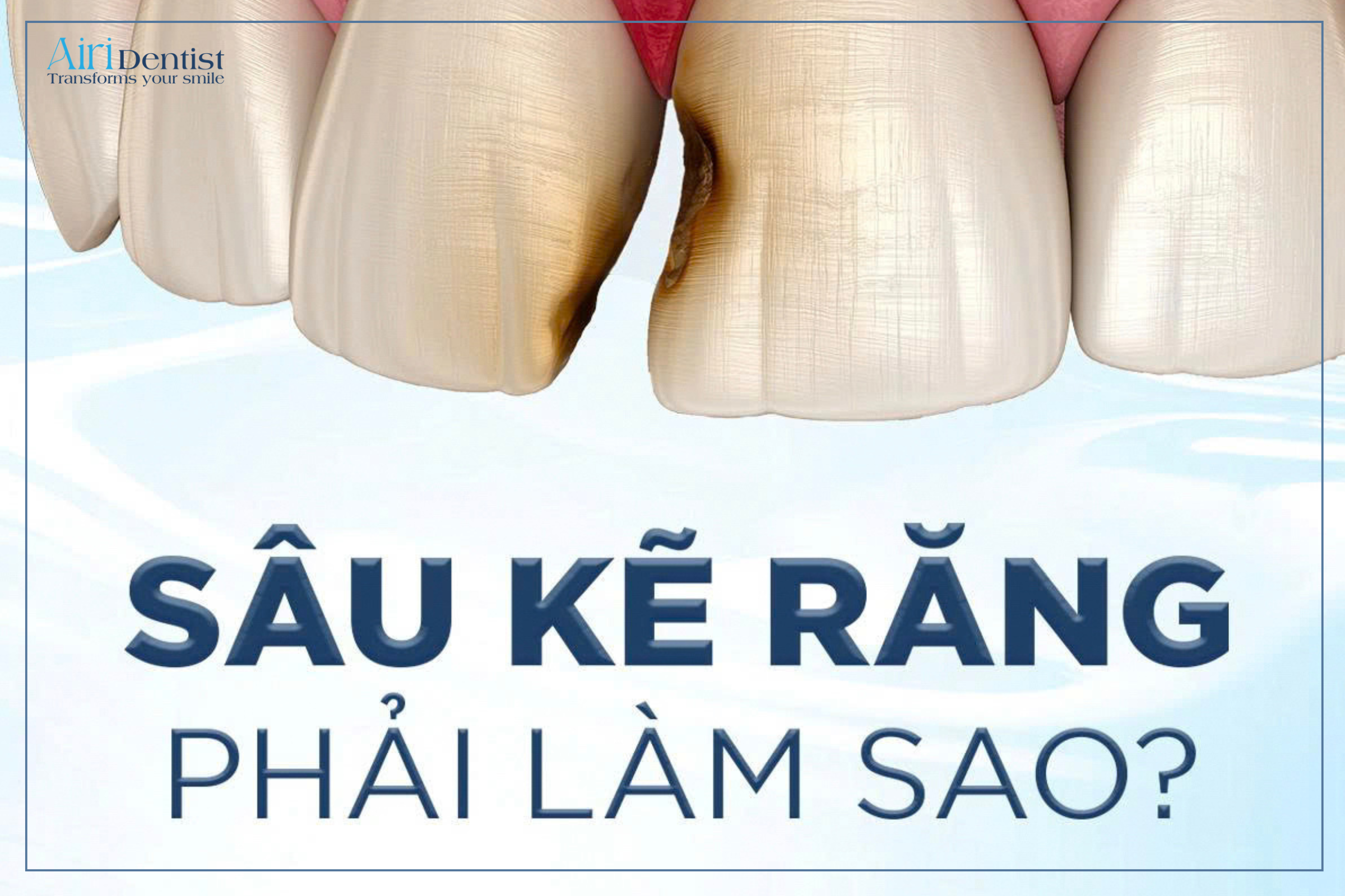 Bị sâu kẽ răng phải làm sao? Tìm hiểu ngay nguyên nhân, dấu hiệu nhận biết và các phương pháp trám răng, bọc sứ an toàn, chuẩn y khoa để khắc phục triệt để và tránh nguy cơ mất răng