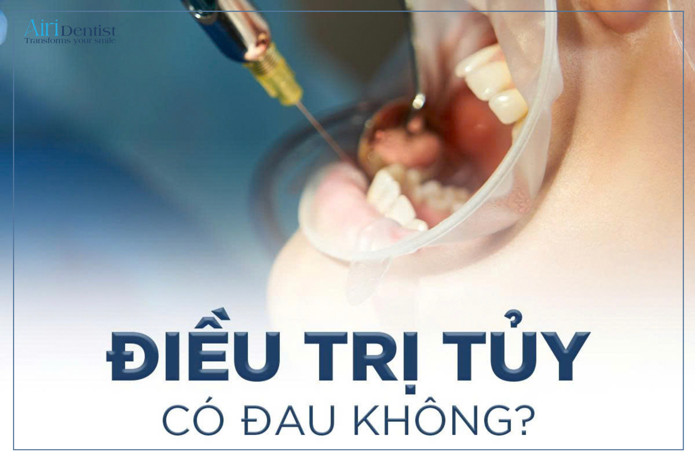 Giải mã thắc mắc điều trị tủy răng có đau không. Hướng dẫn cách nhận biết dấu hiệu phục hồi bình thường và cách giảm ê buốt hiệu quả tại nhà.