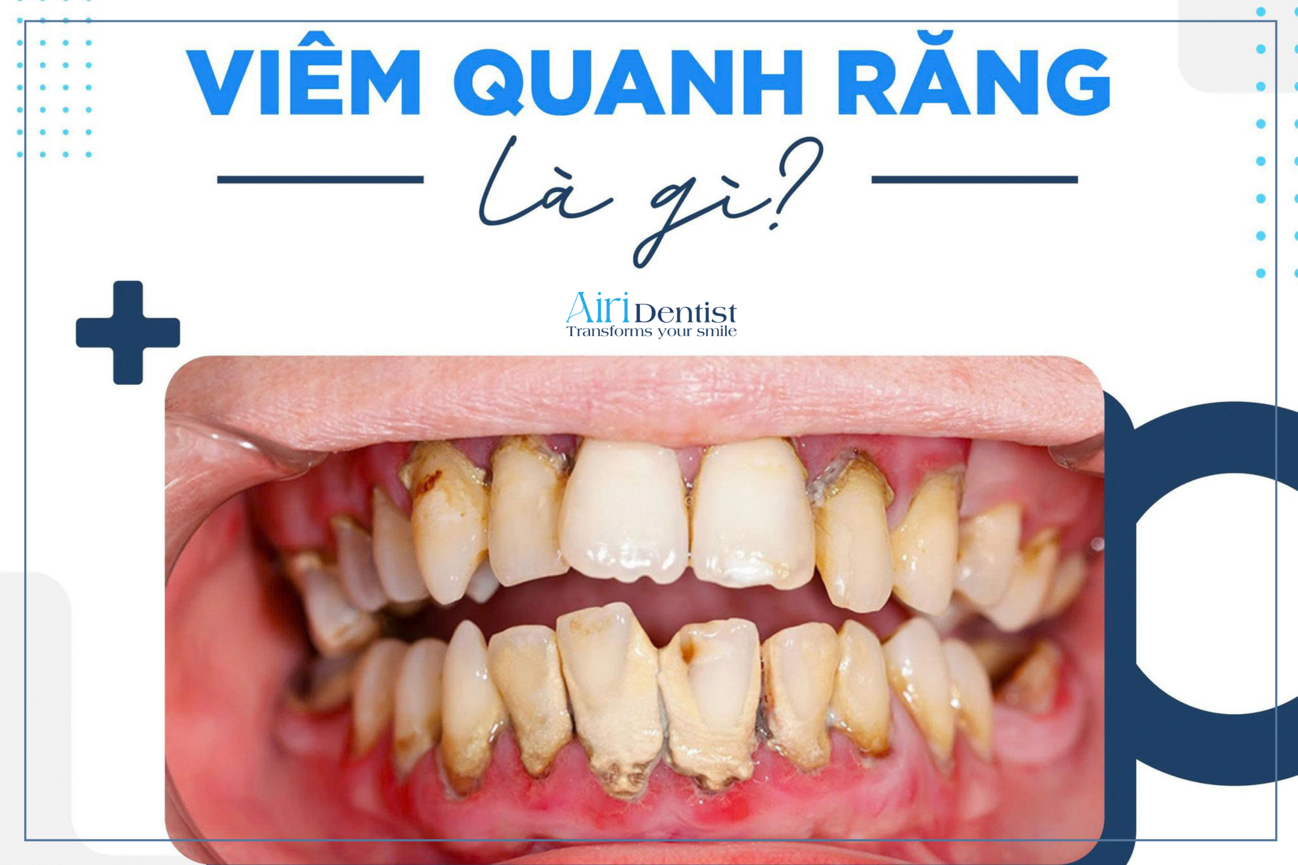 Viêm quanh răng thực chất là viêm nha chu. Tìm hiểu ngay nguyên nhân, dấu hiệu cảnh báo và phương pháp điều trị dứt điểm để ngăn chặn nguy cơ rụng răng."