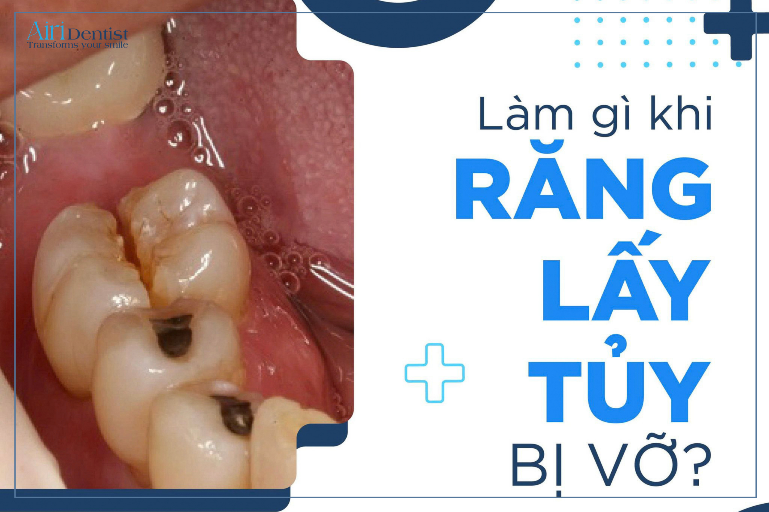 Giải đáp chi tiết nguyên nhân gây vỡ răng sau khi lấy tủy. Tìm hiểu giải pháp phục hình dứt điểm khi răng lấy tủy bị vỡ để bảo vệ nụ cười khỏe mạnh tự nhiên.