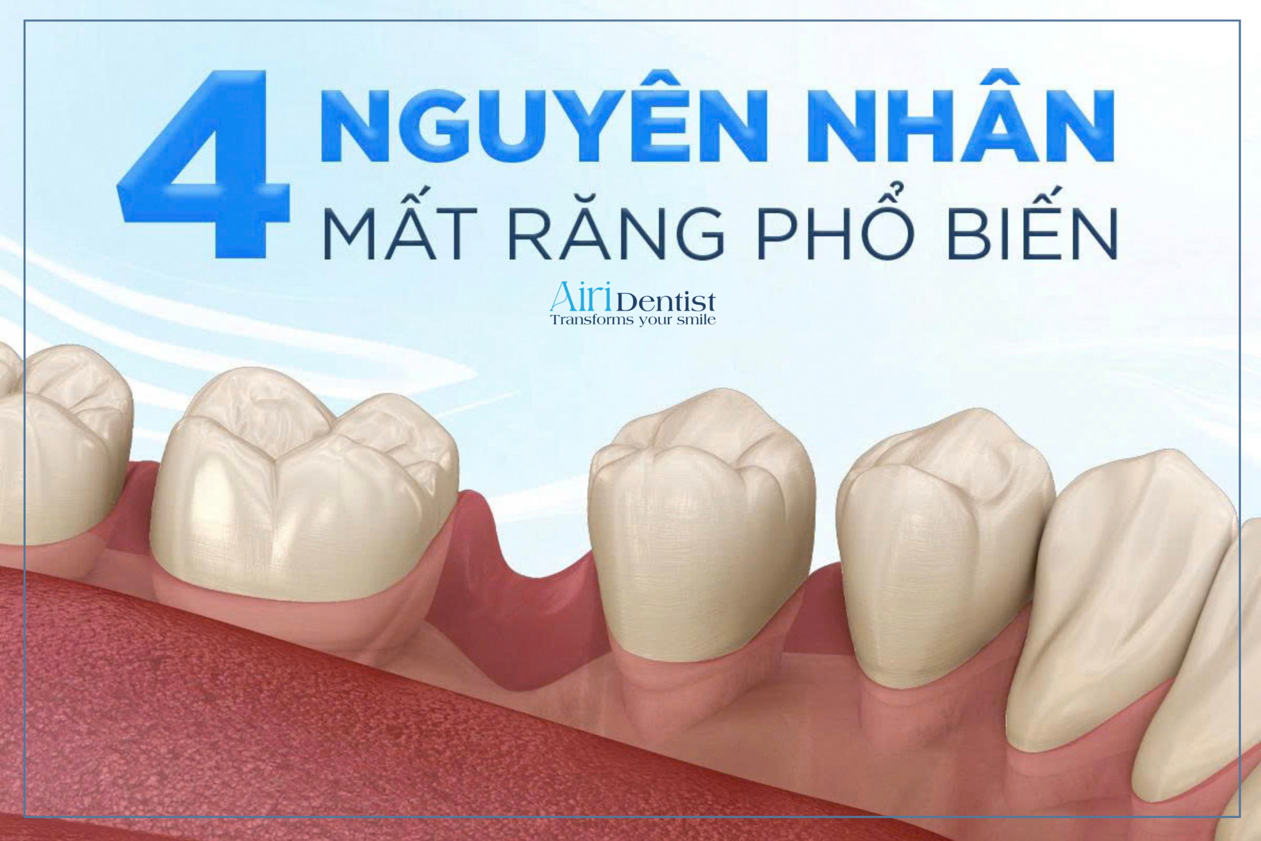 Giải đáp chi tiết 4 nguyên nhân y khoa gây mất răng phổ biến từ sâu răng, nha chu đến chấn thương. Khám phá giải pháp phục hình dứt điểm tại AIRI Dentist giúp ngăn chặn tiêu xương hàm.
