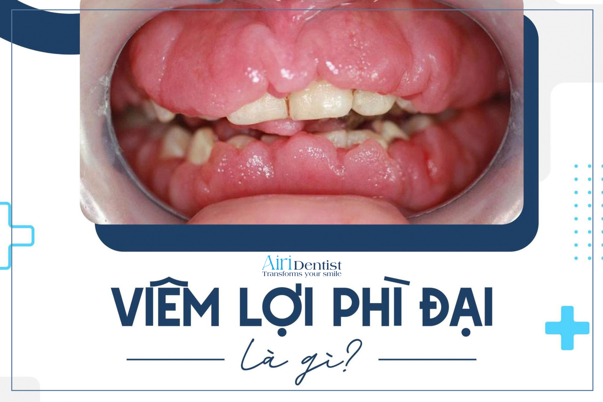 Giải đáp chi tiết viêm lợi phì đại là gì, nguyên nhân y khoa và dấu hiệu nhận biết rõ ràng. Khám phá giải pháp điều trị dứt điểm giúp bảo vệ nướu răng khỏe mạnh.
