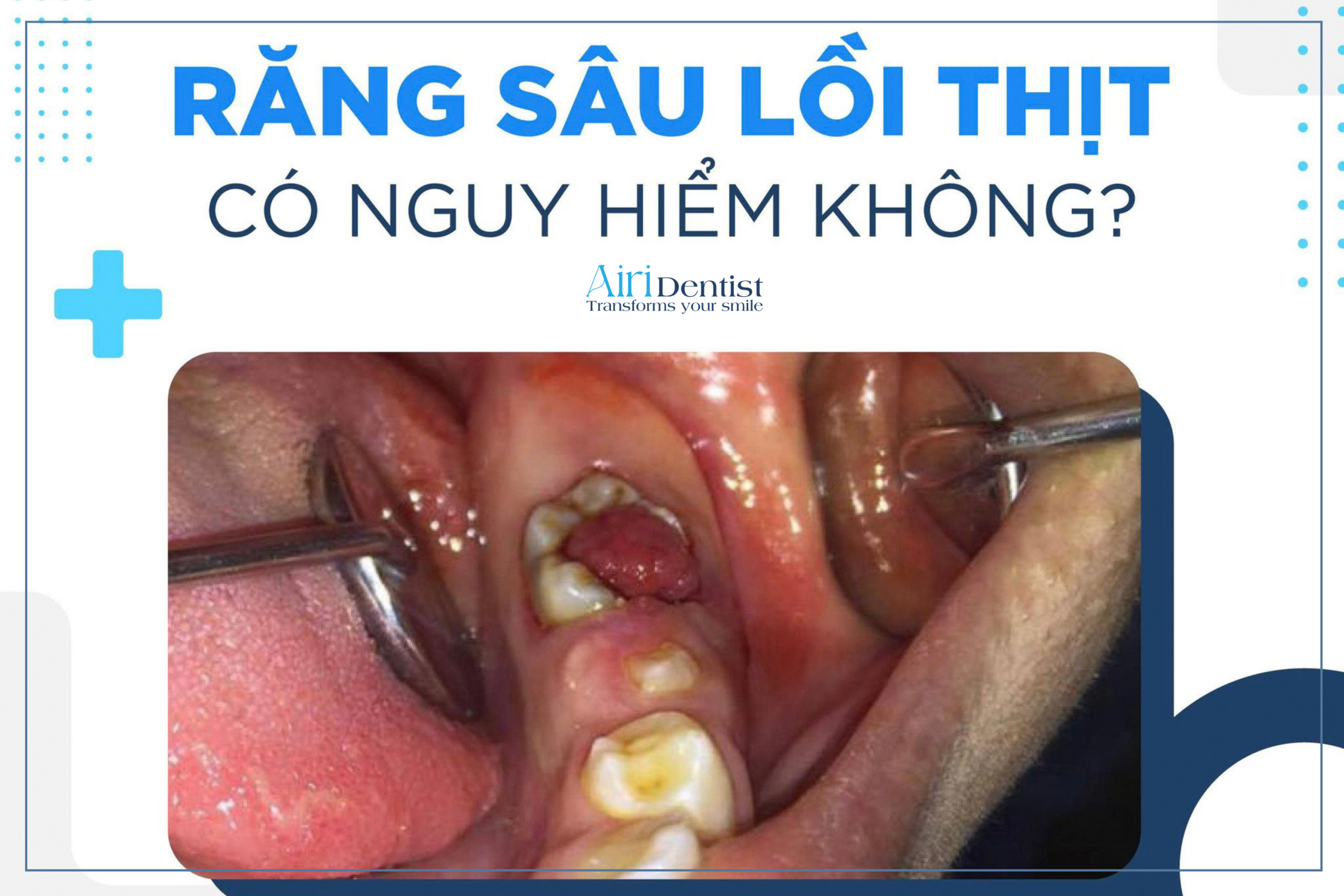 Cùng chuyên gia giải đáp răng sâu lồi thịt có nguy hiểm không. Khám phá bản chất y khoa, các biến chứng nghiêm trọng và phác đồ điều trị dứt điểm bảo vệ răng thật.