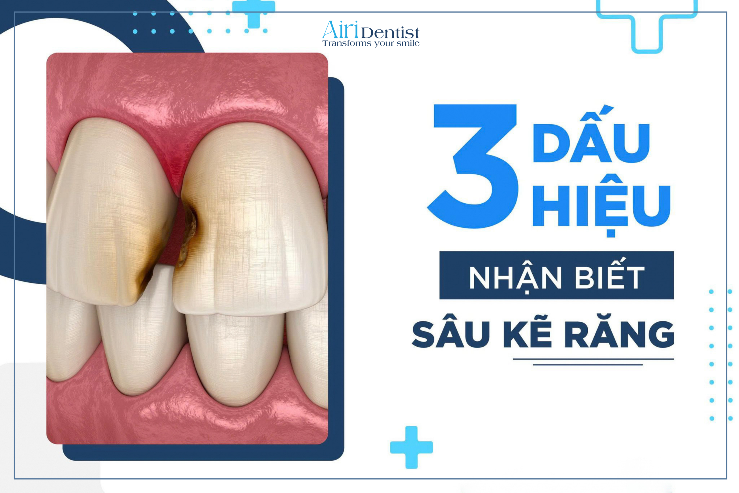 Giải đáp chi tiết 3 dấu hiệu nhận biết sâu kẽ răng điển hình từ bác sĩ chuyên khoa. Khám phá ngay phác đồ điều trị dứt điểm giúp bảo vệ và giữ gìn răng thật.
