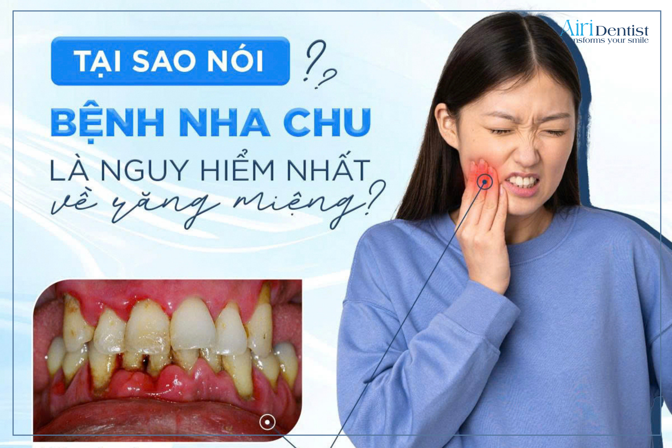 Đừng chủ quan khi nướu sưng viêm! Tìm hiểu cơ chế viêm nha chu gây mất răng vĩnh viễn và cách bảo vệ cấu trúc xương hàm an toàn