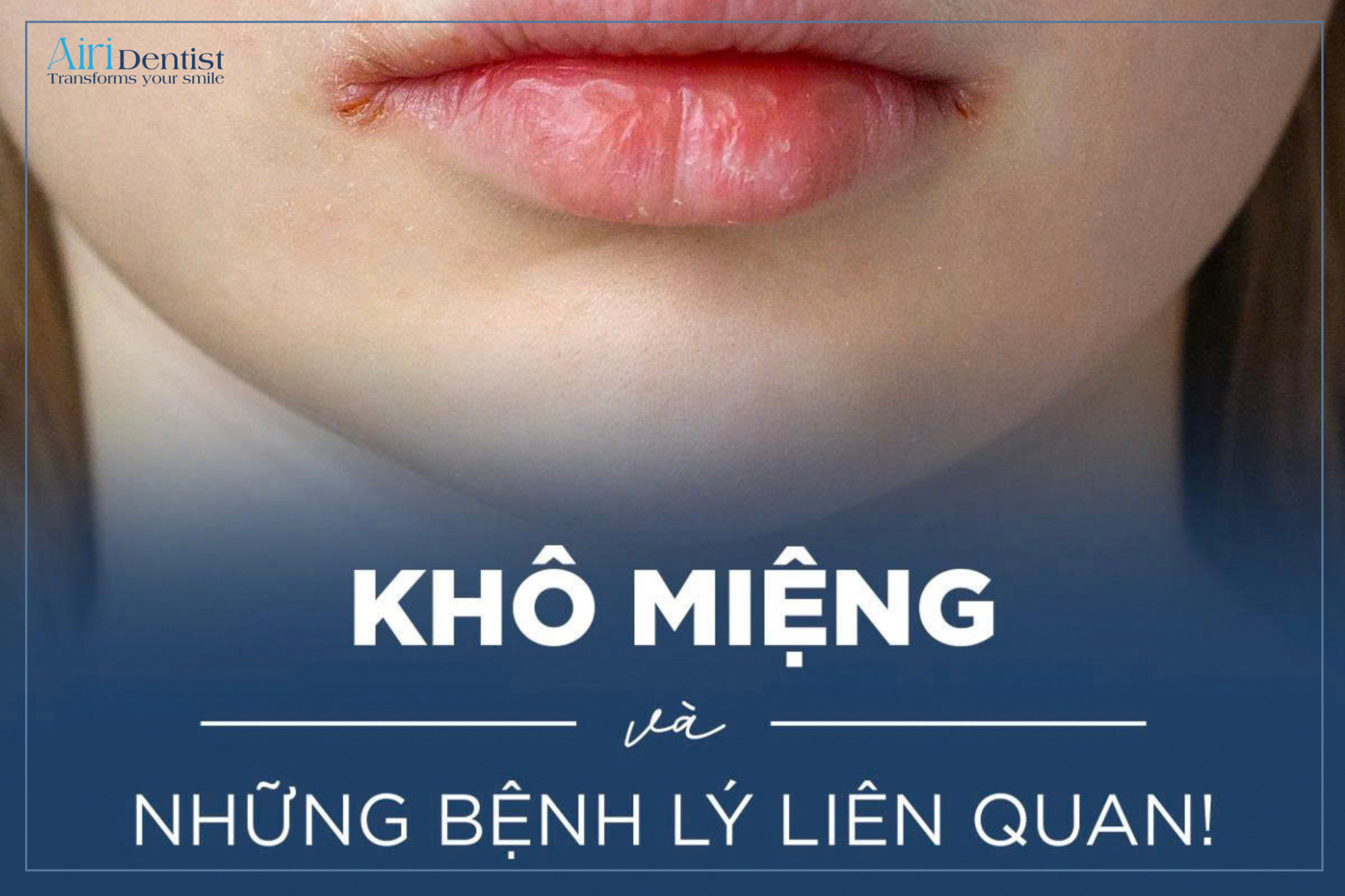 Giải đáp y khoa về tình trạng khô miệng và những bệnh lý liên quan. Phân tích nguyên nhân suy giảm tiết nước bọt và hướng dẫn phác đồ khắc phục chuẩn khoa học để ngăn ngừa sâu răng, viêm nướu.